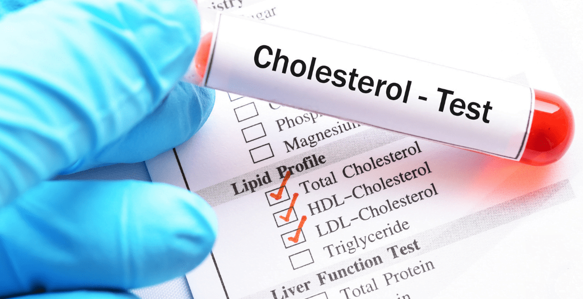 Test tube labelled "Cholesterol - Test"