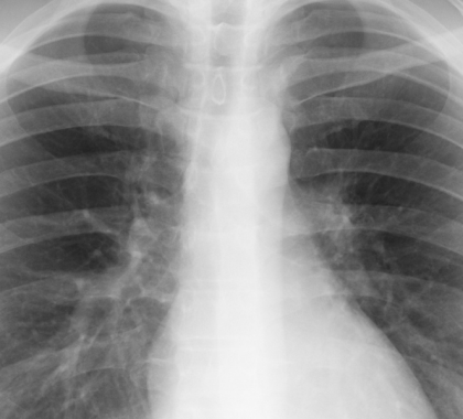 X-ray image of a human's lungs